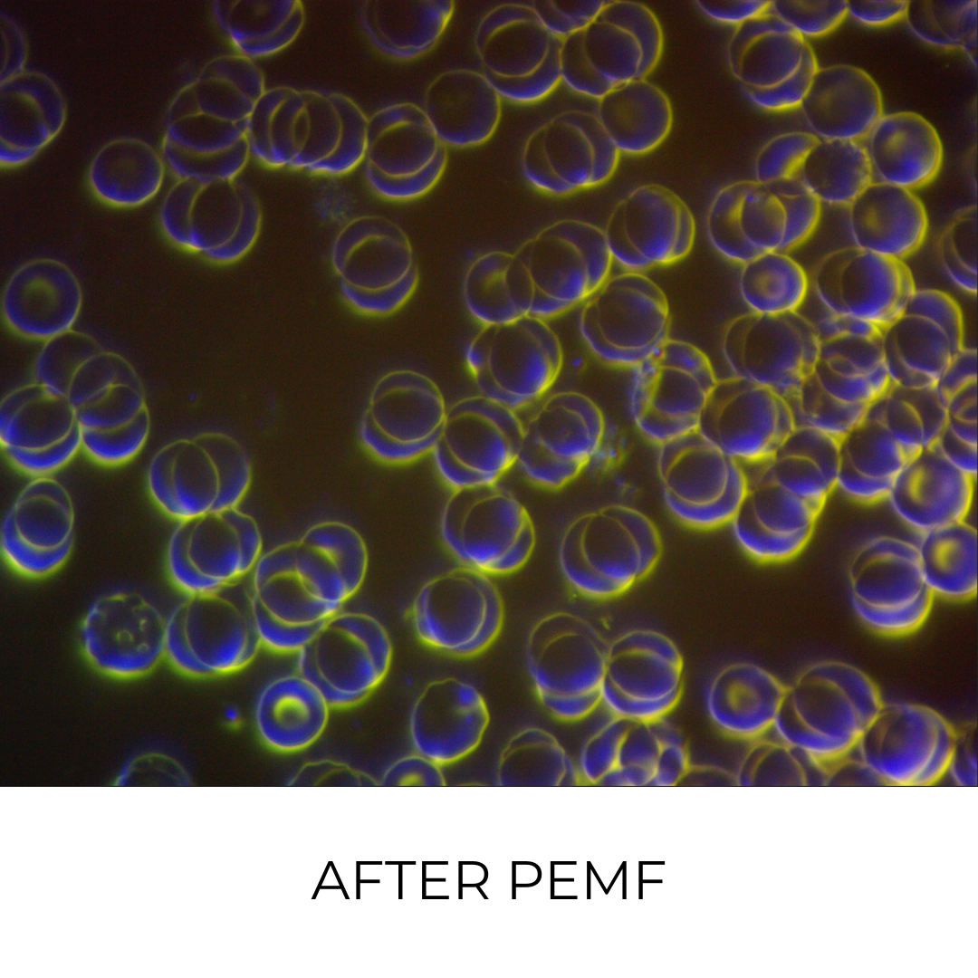 Live blood analysis of cells after a PEMF session